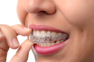 Orthodontist - Invisalign Braces